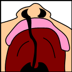 Celah bibir dan lelangit unilateral