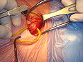 Thumbnail for Inguinal hernia surgery