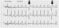 Extrasistole ventricolare: è un battito cardiaco prematuro, ossia un evento elettrico del muscolo cardiaco che avviene prima del previsto, alterando la successione regolare dei battiti nel ritmo sinusale.[55]