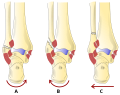 Fracturarum fibulae typi A, B, C secundum Weber