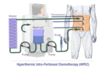 Thumbnail for Hyperthermic intraperitoneal chemotherapy