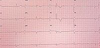 Miniatura para Bloqueio atrioventricular do terceiro grau