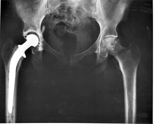 Radiographie d’un patient avec une prothèse de hanche en métal et en plastique au membre inférieur droit. (définition réelle 5 556 × 4 468*)