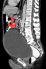 Thumbnail for Urinary retention