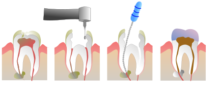 Root Canal Illustration Molar