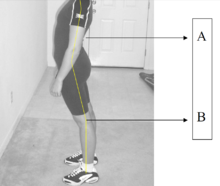 Hiperlordosis