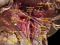 Muscles, arteries and nerves of neck.Newborn dissection.