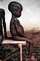 Finales de la década de los 60, la fotografía muestra un sentó, niño apático que estaba entre muchos casos del kwashiorkor encontrados en los campamentos de alivio Nigerianos durante la guerra entre Nigeria y Biafra. Por Dr. Lyle Conrad.