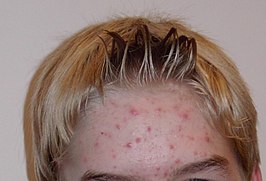 Acne bij een 14-jarige jongen