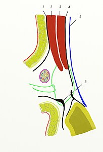 Ryc. 8. Pierwszy tzw. „szew Bassiniego” 1. Aponeurosis musculi obliq. ext.; 2. Musculus obliquus internus; 3. Musculus transversalis; 4. Fascia transversalis; 5. Peritoneum; 6. Ligamentum inguinale.