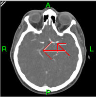 Emberi koponya CT-szelete, nyilak mutatják az ereket