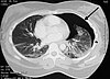 Pneumothorax CXR