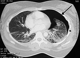 Description de l'image Pneumothorax CT.jpg.