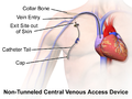 Thumbnail for Central venous catheter