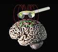 Thumbnail for Transcranial magnetic stimulation