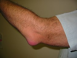 Bursitis_Elbow_WC.JPG