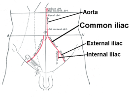 {Schematische weergave van het verloop van de aorta en arteria iliaca communis.