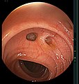 Colonic diverticulum