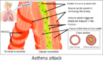 Thumbnail for Asthma