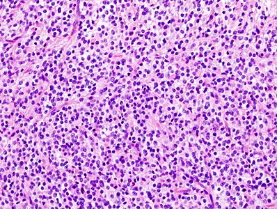 Imagem histopatológica de oligodendroglioma anaplásico no cérebro. Coloração de hematoxilina e eosina.