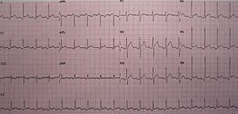 Een ECG passend bij pericarditis. Specifiek voor pericarditis is de ST elevatie in meerdere afleidingen en een minimale reciproke ST depressie in aVR.