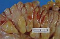 Large bowel (sigmoid colon) showing multiple diverticula: the diverticula appear on either side of the longitudinal muscle bundle (taenium).