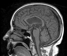 Een sagittale MRI-afbeelding toont atrofie in het mesencephalon kenmerkend voor PSP.