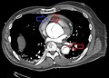 Type A dissection with pericardial effusion as a result.