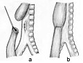 May 23: operative repair of esophageal atresia