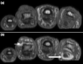 Az ujjak MR képe arthritis psoriatica esetén. A képeken T1 súlyozott axiális (a) kontraszt előtti és (b) kontraszt utáni felvételek, amelyeken ínhüvelygyulladás okozta dactylitis a második ujjnál, az ínhüvely megvastagodása jól kivehető (nagy nyíl). A negyedik proximális interfalangeális ízületben synovitis látható (kis nyíl).