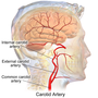 Thumbnail for Internal carotid artery