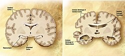 Alzheimer's_disease_brain_comparison.jpg