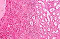 Micrograph of a renal oncocytoma. H&E stain.