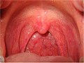 Acute catarrhal pharyngitis. The oropharynx is swollen and red