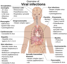 A photograph of the upper body of a man labelled with the names of viruses that infect the different parts