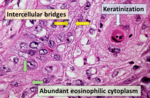 Thumbnail for Squamous-cell carcinoma