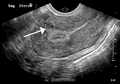 A small uterine fibroid seen within the wall of the myometrium on a cross-sectional ultrasound view