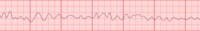 Fibrillazione ventricolare è un'aritmia cardiaca rapidissima, caotica, che provoca contrazioni non coordinate del muscolo cardiaco e deve essere riconvertita rapidamente con la defibrillazione. L'aspetto del tracciato è caratterizzato dalla presenza di fini onde, desincronizzate.[55][56]