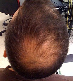 Androgenic alopecia (baldness) illustrated in a male.