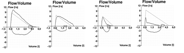 Typische Fluss-Volumen-Diagramme bei (v. l. n. r.) normaler Atmung, fehlender Mitarbeit des Patienten, Asthma, und COPD