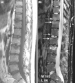 (a) T1-súlyozott és (b) STIR (short time inversion recovery) zsírszupressziós technikával készült MR felvétel az ágyéki és a mellkasi gerinc alsó részén arthritis psoriatica esetén. Az aktív gyulladás jelei több szinten is láthatók, illetve a nyilak jelölik. Különösen az L1/L2 szintnél látható elülső spondylitis, valamint az L3 felső csigolya véglemezénél gyulladásos Andersson lézió.