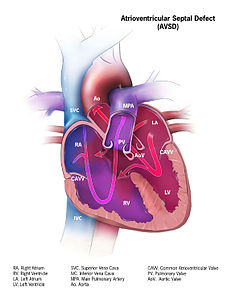 Atrioventriculair-septumdefect