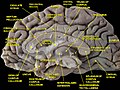 Medial surface of cerebral hemisphere. Medial view. Deep dissection.