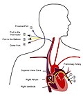 Thumbnail for Pulmonary artery catheter