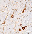 アルツハイマー病患者の大脳皮質の神経細胞体 (矢印) と突起 (process)(矢尻) のタウオパチー (茶色) の顕微鏡写真。バー＝25ミクロン (0.025 mm)。