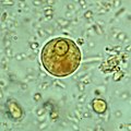 Immature Entamoeba histolytica cyst (mature cysts have 4 nuclei)