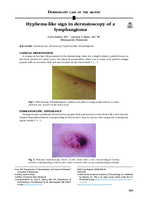 First page of “Hyphema-like sign in dermatoscopy of a lymphangioma”