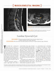 Research paper thumbnail of Lumbar Synovial Cyst