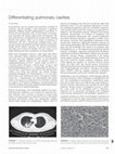 Research paper thumbnail of Differentiating pulmonary cavities