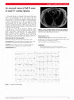 Research paper thumbnail of An unusual cause of tall R wave in lead V1: cardiac lipoma